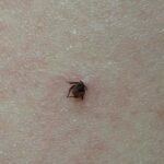 Na zdjęciu samica kleszcza pospolitego (Ixodes ricinus) wbita w skórę. Niedawno takiego właśnie kleszcza wyjął jeden z naszych pacjentów. Dla wielu osób to tylko drobna, ciemna „kropka” na skórze, ale w praktyce medycznej każdy taki przypadek jest ważny: liczy się szybkie i prawidłowe usunięcie kleszcza, ocena miejsca wkłucia oraz obserwacja objawów w kolejnych dniach i tygodniach. Ten cykl zdjęć ma pomóc pacjentom lepiej rozpoznawać, jak mogą wyglądać kleszcze wbite w skórę lub już usunięte z ciała — i kiedy warto skonsultować się z lekarzem.